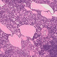 基底細胞腺腫